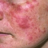 Srbija i zdravlje: Šta je lupus i kako se leči 11