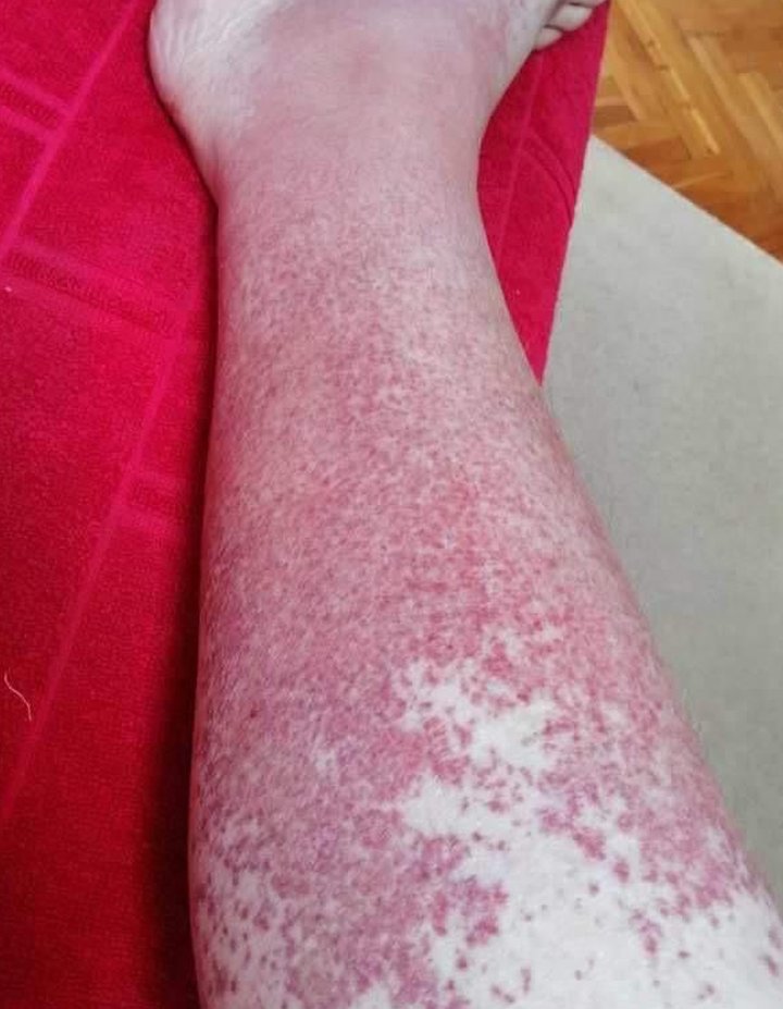 Srbija i zdravlje: Šta je lupus i kako se leči 4 Osip na nogama