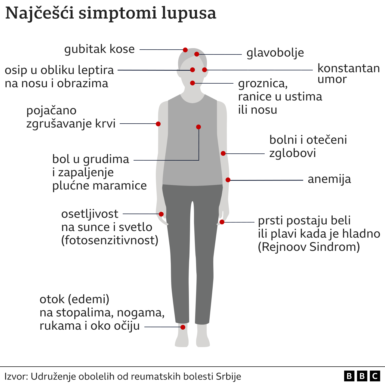 Srbija i zdravlje: Šta je lupus i kako se leči 3 lupus, simptomi lupusa