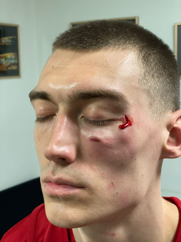 Košarkaš Zvezde dao iskaz u MUP-u o tuči sa Nanelijem: Krenuo je da uzmiče, ali me je potom udario 2 Košarkaš Zvezde dao iskaz u MUP-u o tuči sa Nanelijem: Krenuo je da uzmiče, ali me je potom udario 1