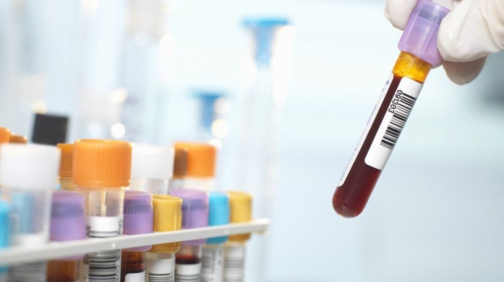 Tumačenje kompletne krvne slike (KKS) za početnike 1