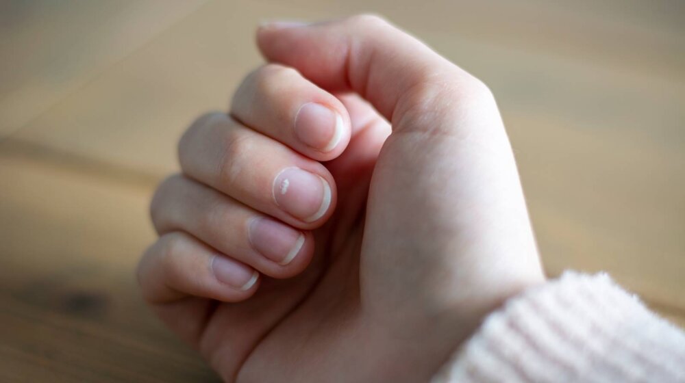 Ova mala promena na noktu može biti simptom raka 1