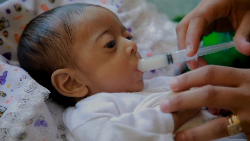 Izrael i Palestinci: Očajna majka moli za hranu za njenu petomesečnu bebu 2 Abdulaziz dobija hranu preko šprica