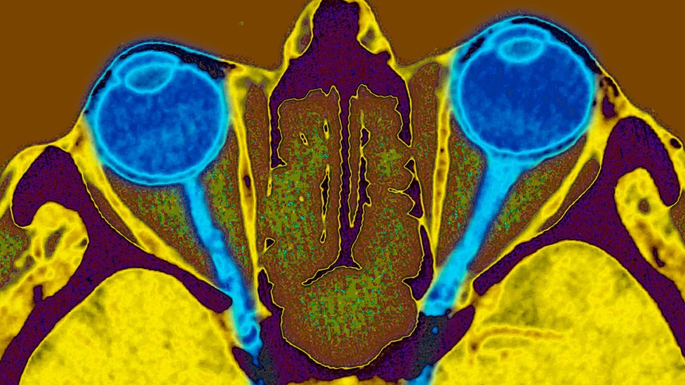Trovanje metanolom: Kako telo reaguje na ilegalna alkoholna pića 7 Rendgenski snimak očiju