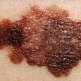 Crna statistika: "Po obolevanju od melanoma smo u sredini, ali po smrtnosti u samom vrhu evropskih zemalja" 3