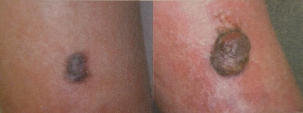 Crna statistika: "Po obolevanju od melanoma smo u sredini, ali po smrtnosti u samom vrhu evropskih zemalja" 6