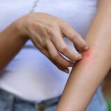 prirodan repelent, komarci