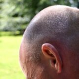 Zdravlje: „Svima pričam da sam presadila kosu" 3