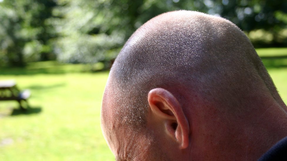 Zdravlje: „Svima pričam da sam presadila kosu" 1 Presađivanje kose