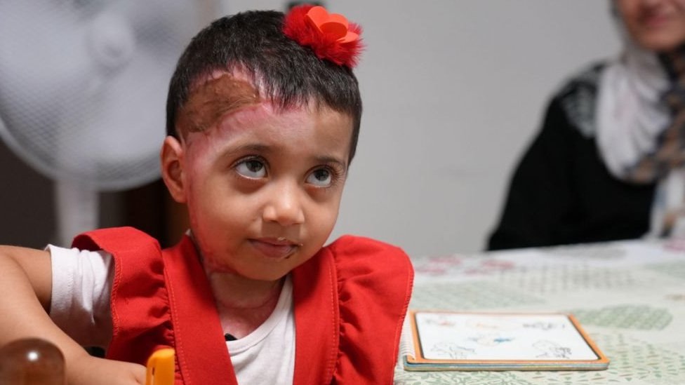 Posle meseci čekanja, devojčice iz Gaze stigle su u Italiju na lečenje opekotina 1 Zeina