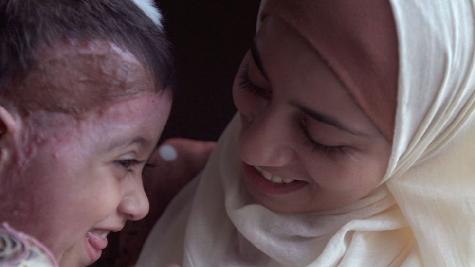 Posle meseci čekanja, devojčice iz Gaze stigle su u Italiju na lečenje opekotina 5 Zejna i njena majka Šaima