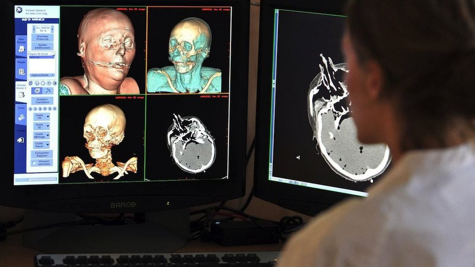 Indija: Doktorka veteranka za autopsije koja je videla smrt u svakom stadijumu života 5 Virtuelne autopsije rade se uz pomoć slika dobijenih preko CT skenova, magnetne rezonance i sonografije da bi se proučila tela