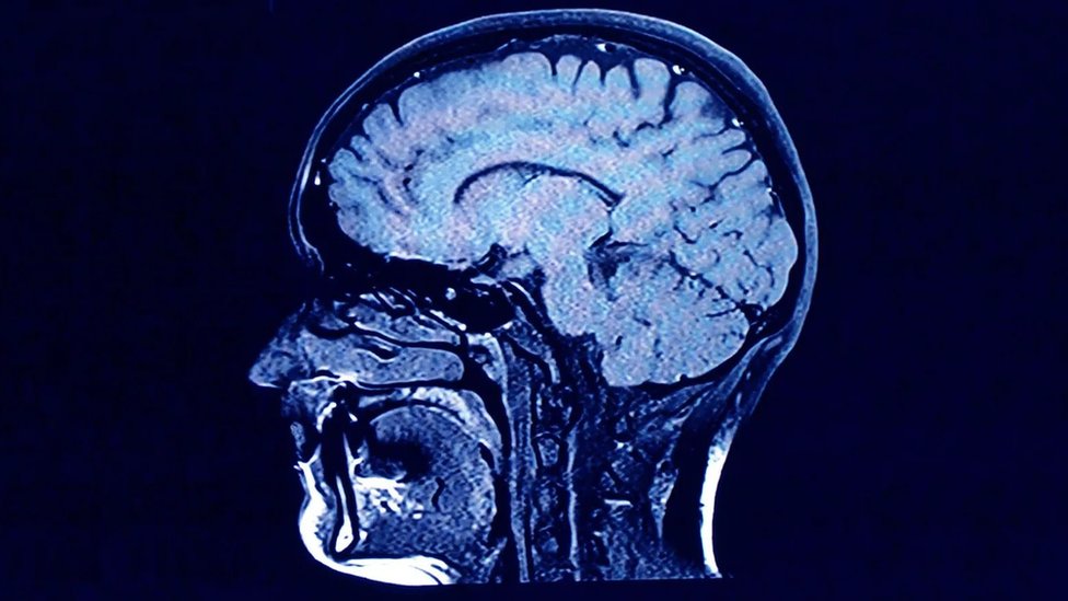 Nauka: Šiljak bomba, skriveno nasleđe nuklearnog oružja u ljudskim ćelijama 3 Neuroni, mozak, šiljak bombe