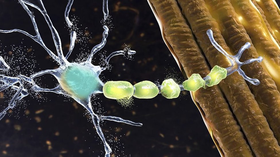 Zdravlje: Amiotrofična lateralna skleroza i danas neizlečiva bolest čiji je uzrok misterija 1 ALS