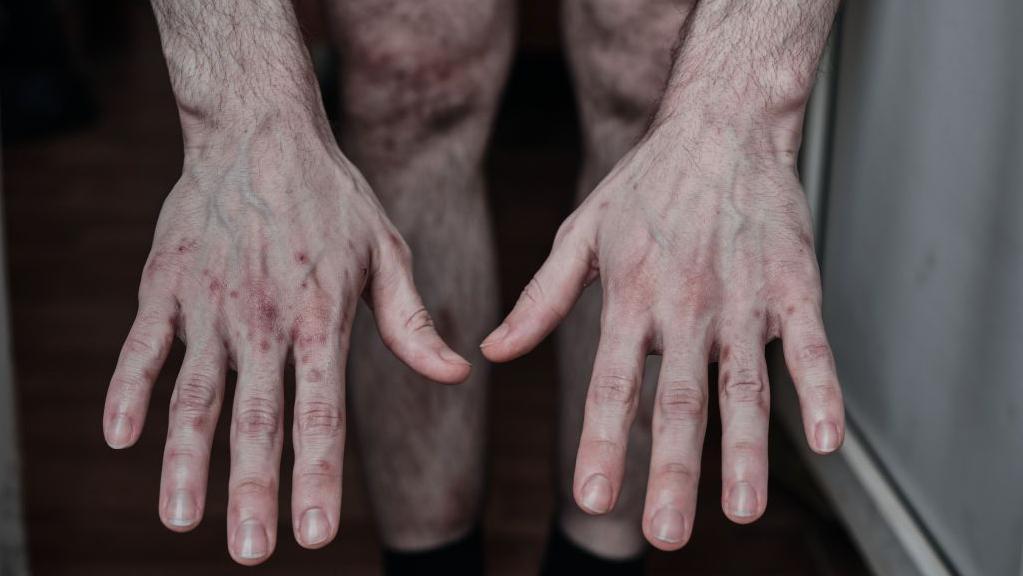 „Ćutao sam jer je bilo neophodno”: Ukrajinski ratni zarobljenik koji nije progovorio godinu dana 4 Ukrajinski vojnik koji je bio u zarobljeništvu pokazuje tragove mučenja