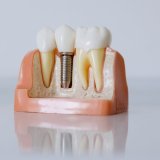 Zašto su zubni implanti najbolje rešenje za nedostatak zuba? 3