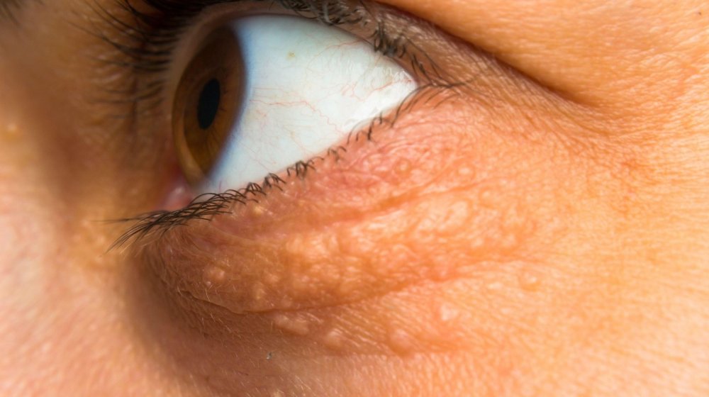 Simptomi visokog holesterola koje možete uočiti na licu 1