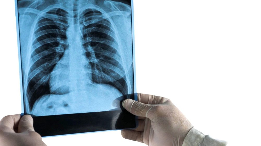 Sve više je zaraženo hodajućom upalom pluća: Ovo su simptomi 1