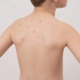 Ovčije boginje: Simptomi i lečenje 1