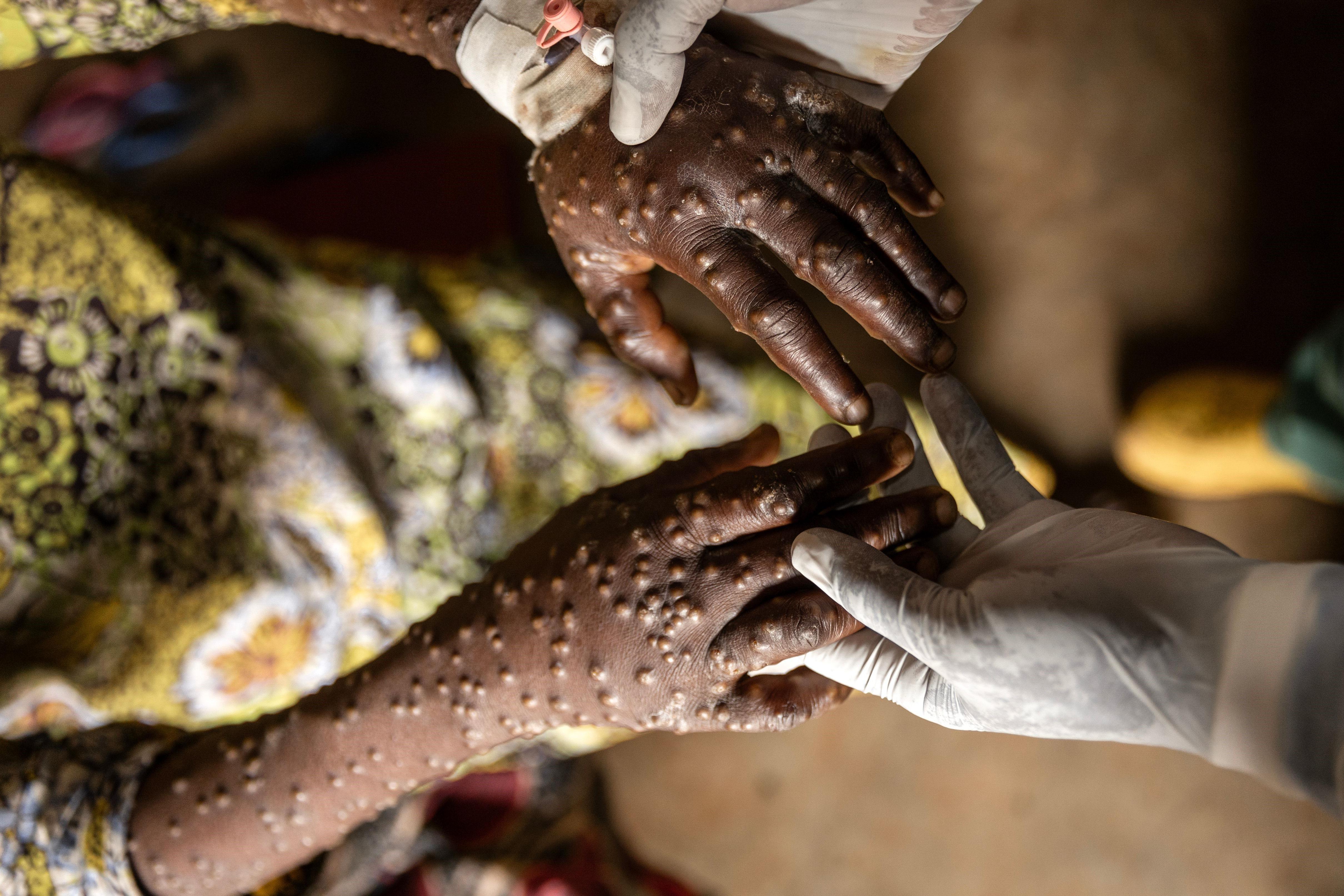 Šta povlačenje Amerike iz Svetske zdravstvene organizacije znači za svet 2 SZO je pomogla da se brzo sprovede program vakcinacije protiv majmunskih boginja nakon katastrofalne epidemije u Demokratskoj Republici Kongoo