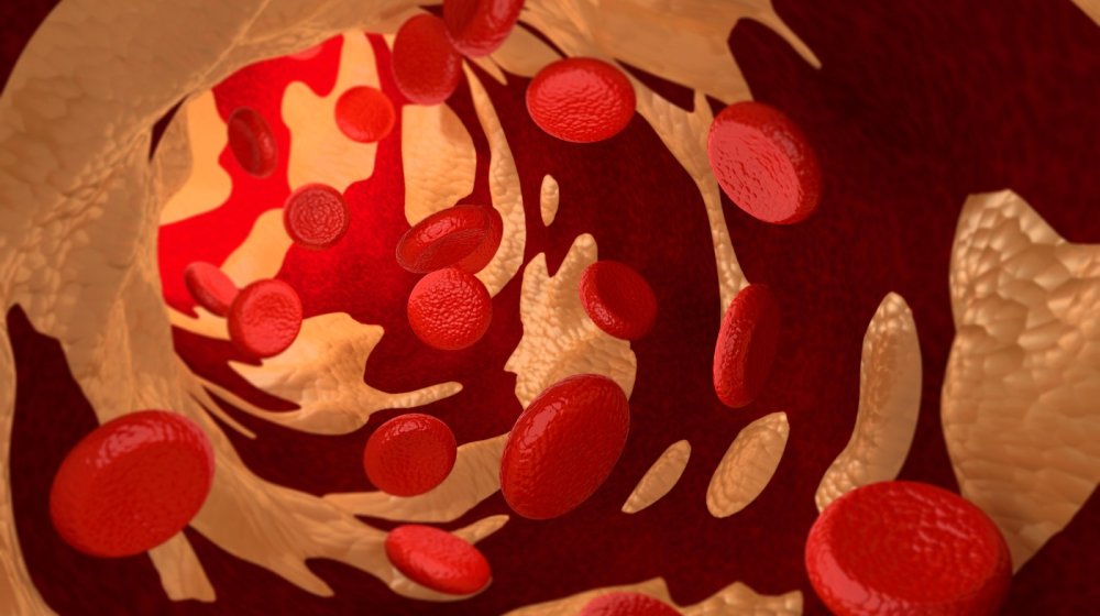 Ovo se dešava sa vašim telom kada imate visok holesterol 1