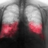 Šta je obostrana upala pluća od koje boluje papa Franja 4