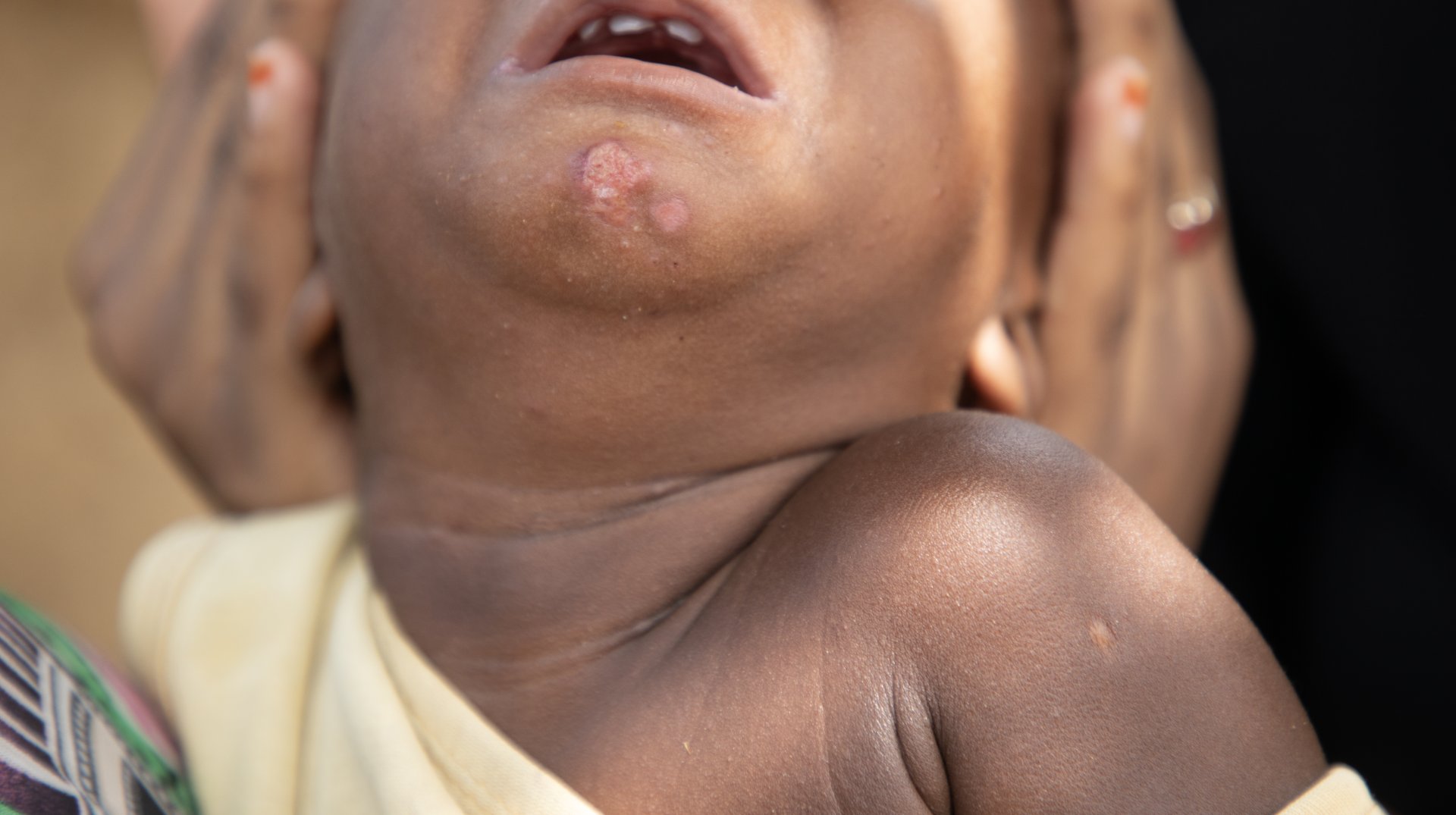 'Mojoj deci sam napravila ožiljke kremom za izbeljivanje kože' 2 Rane kod najmlađeg deteta veoma sporo zarastaju