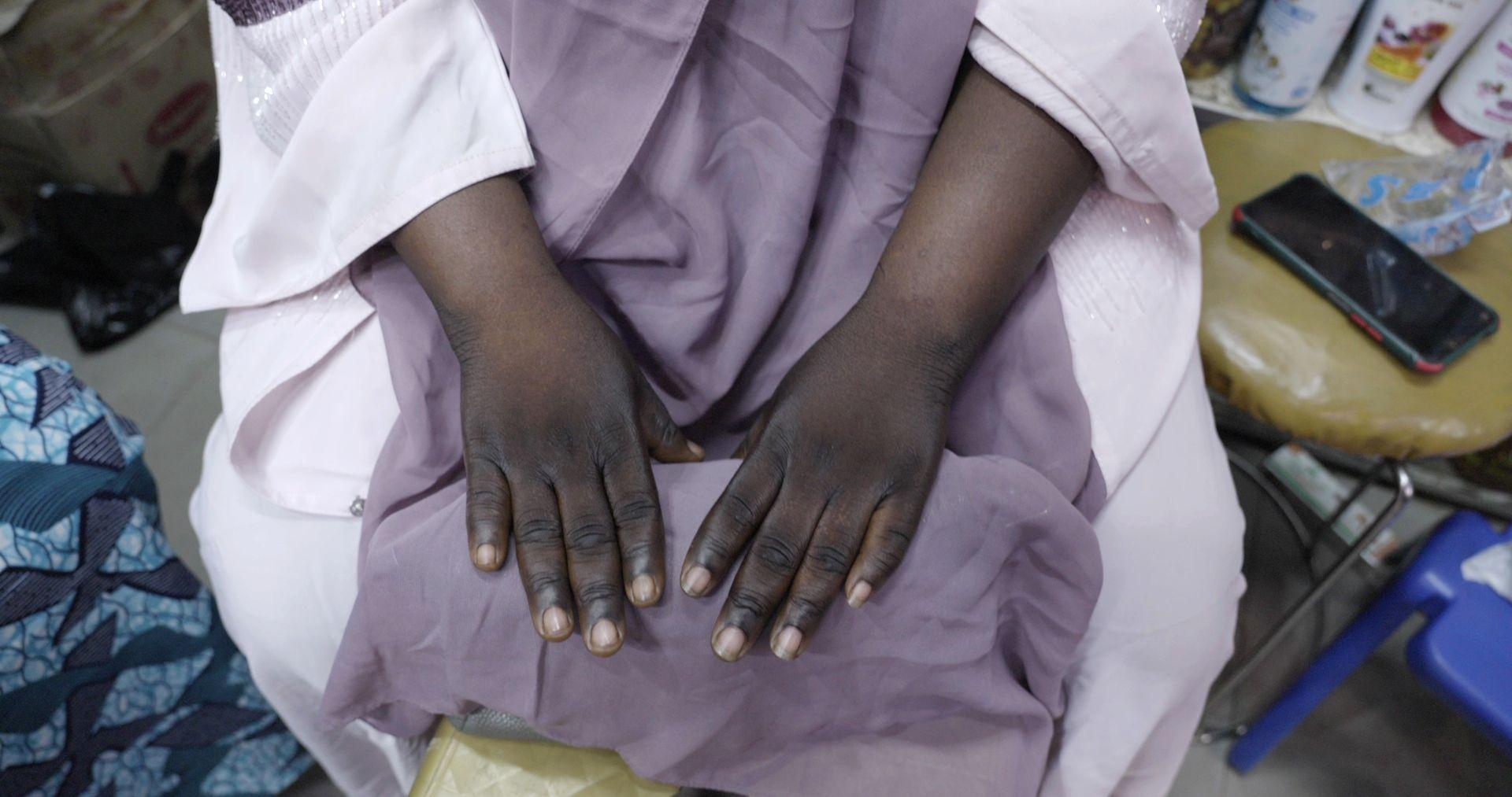 'Mojoj deci sam napravila ožiljke kremom za izbeljivanje kože' 3 Ponekad se smatra da kontrasti boja na izbeljenim rukama podsećaju na tragove koje na rukama imaju narkomani