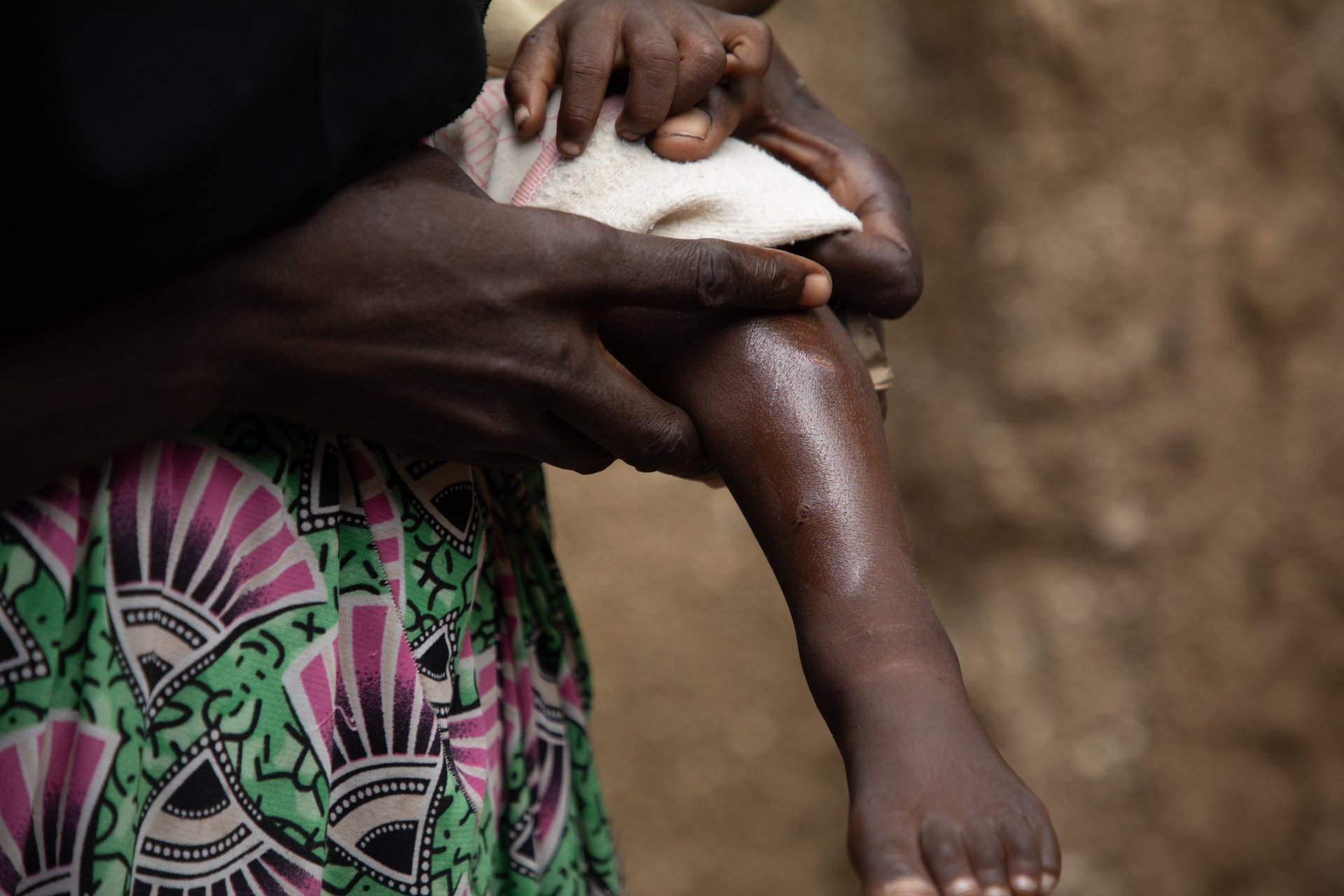 'Mojoj deci sam napravila ožiljke kremom za izbeljivanje kože' 5 proizvod za izbeljivanje kože