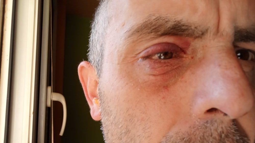 "Jajima gađaju naprednjaci, a ne građani": Nišlija Dušan Ilić prijavio policiji da ga je napala i povredila grupa Vučevih pristalica 1