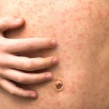 Oprez na odmoru, raste broj obolelih od malih boginja u Evropi 4