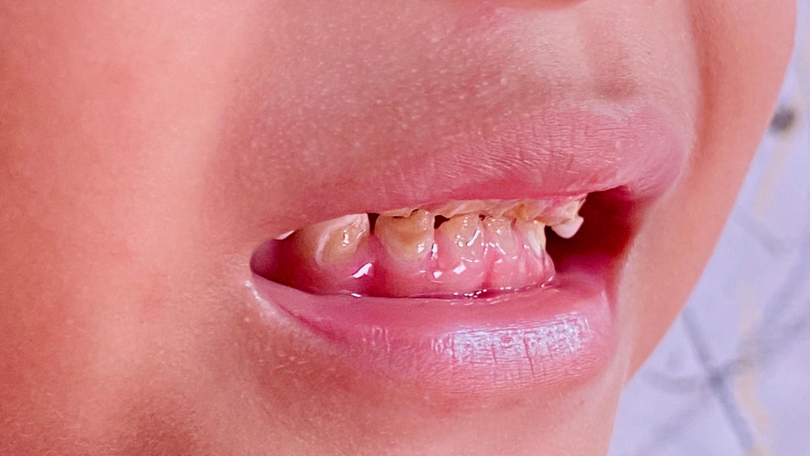 Kako se rešiti neprijatnog zadaha iz usta 5 Pokvareni zubi kod dece