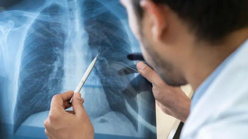 Šta je legionarska bolest koju izaziva bakterija legionela 1 Rendgen pluća