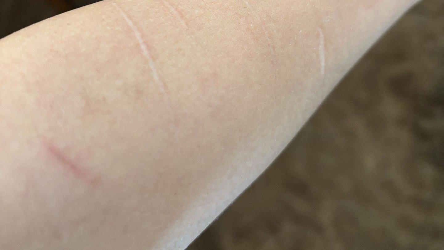 Ožiljci od samopovredjivanja