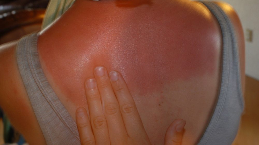 Izgorela je na suncu, a ovaj trik joj je pomogao za pola sata (nije jogurt) 1