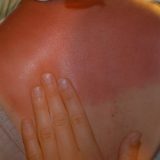 Izgorela je na suncu, a ovaj trik joj je pomogao za pola sata (nije jogurt) 3