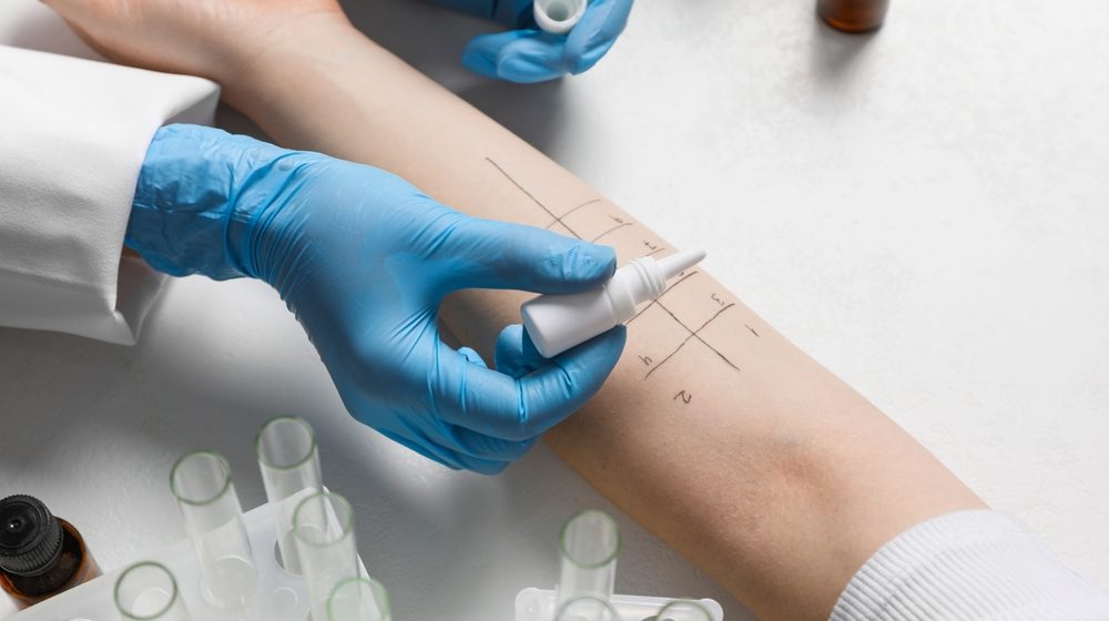 Doktorka Plavšić objašnjava: Šta je alfa-gal sindrom i kako se leči? 1