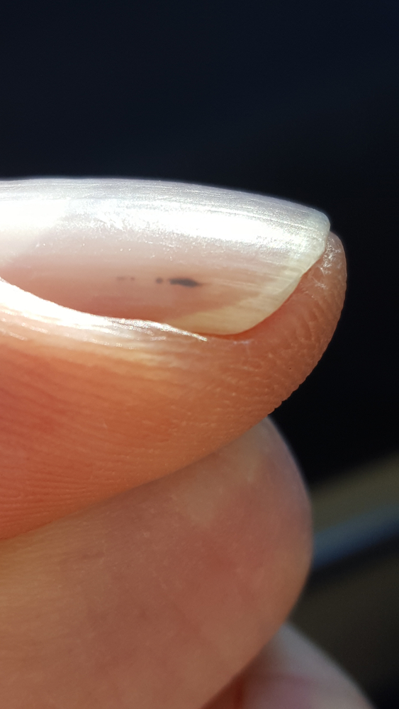 Nokti kao alarm: Promene koje mogu upozoriti na bolesti srca 1