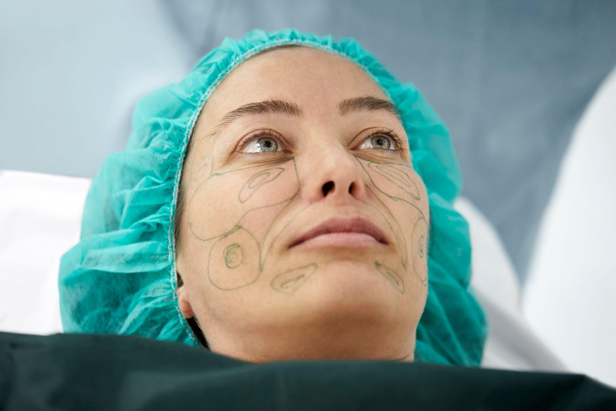 Zatezanje lica u 28. godini: Mladi se okreću plastičnoj hirurgiji 3 Tokom zatezanja lica prave se rezovi s obe strane lica, u blizini ušiju, koji se protežu do linije kose. Zatim se pravi rez na mišiću koji kontroliše izraze lica kako bi se tkivo i mišić mogli pravilno pozicionirati.