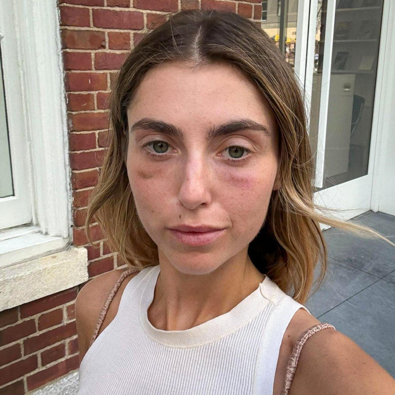 devojka u beloj majici na bretele gleda u kameru, ima tamne krugove oko očiju