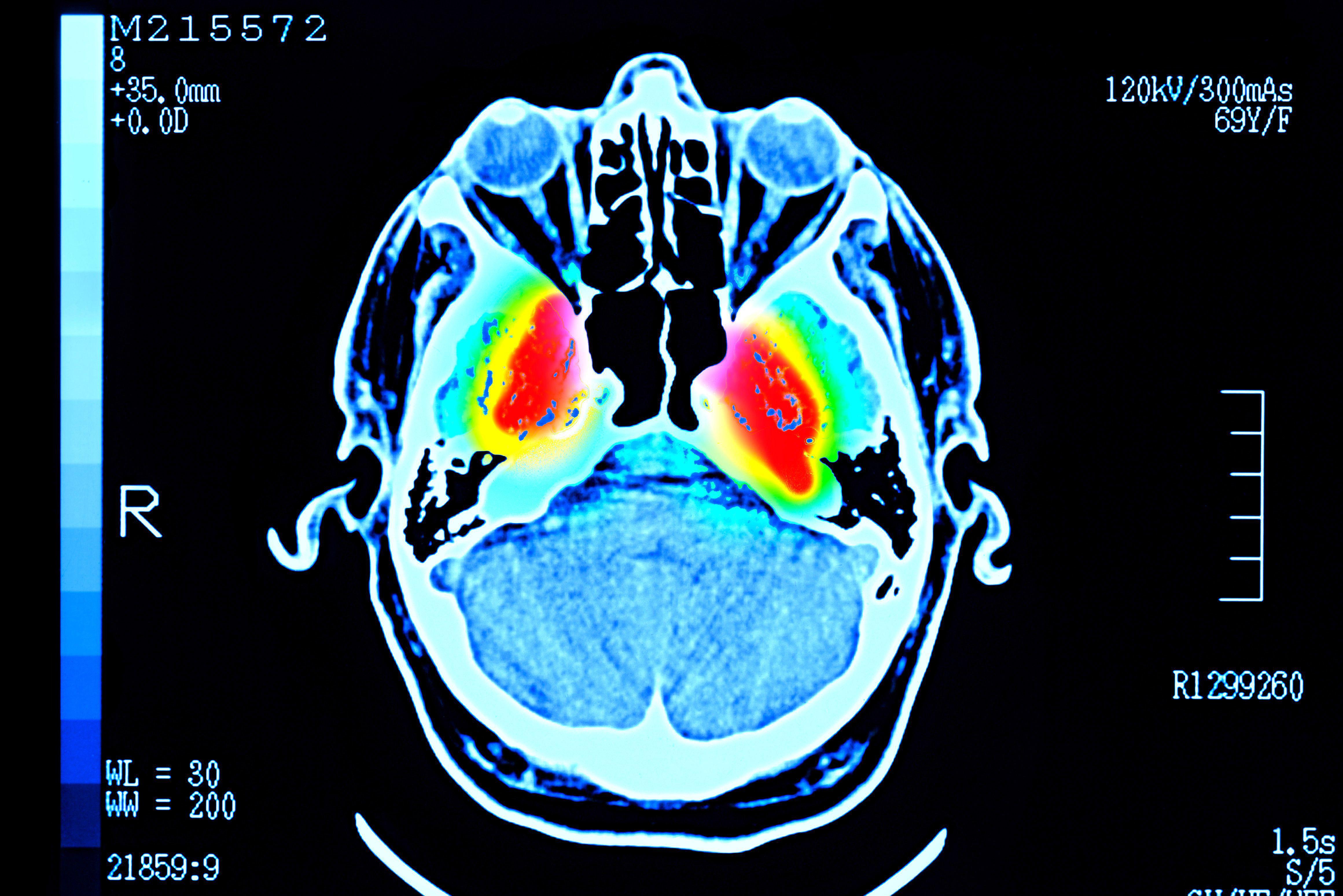 Скенирањето на човечки мозок покажува црвени области околу центарот, опкружени со жолти, зелени и светло сини области.