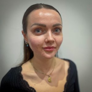 Zaboravite filere, u trendu su injekcije riblje sperme 1