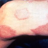 "Batut" saopštio kada je u Srbiji poslednji put registrovana lepra (guba) 6