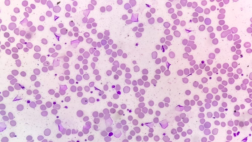 Revolucionarno otkriće: Nova terapija uništila vrstu raka koja je do sada bila neizlečiva