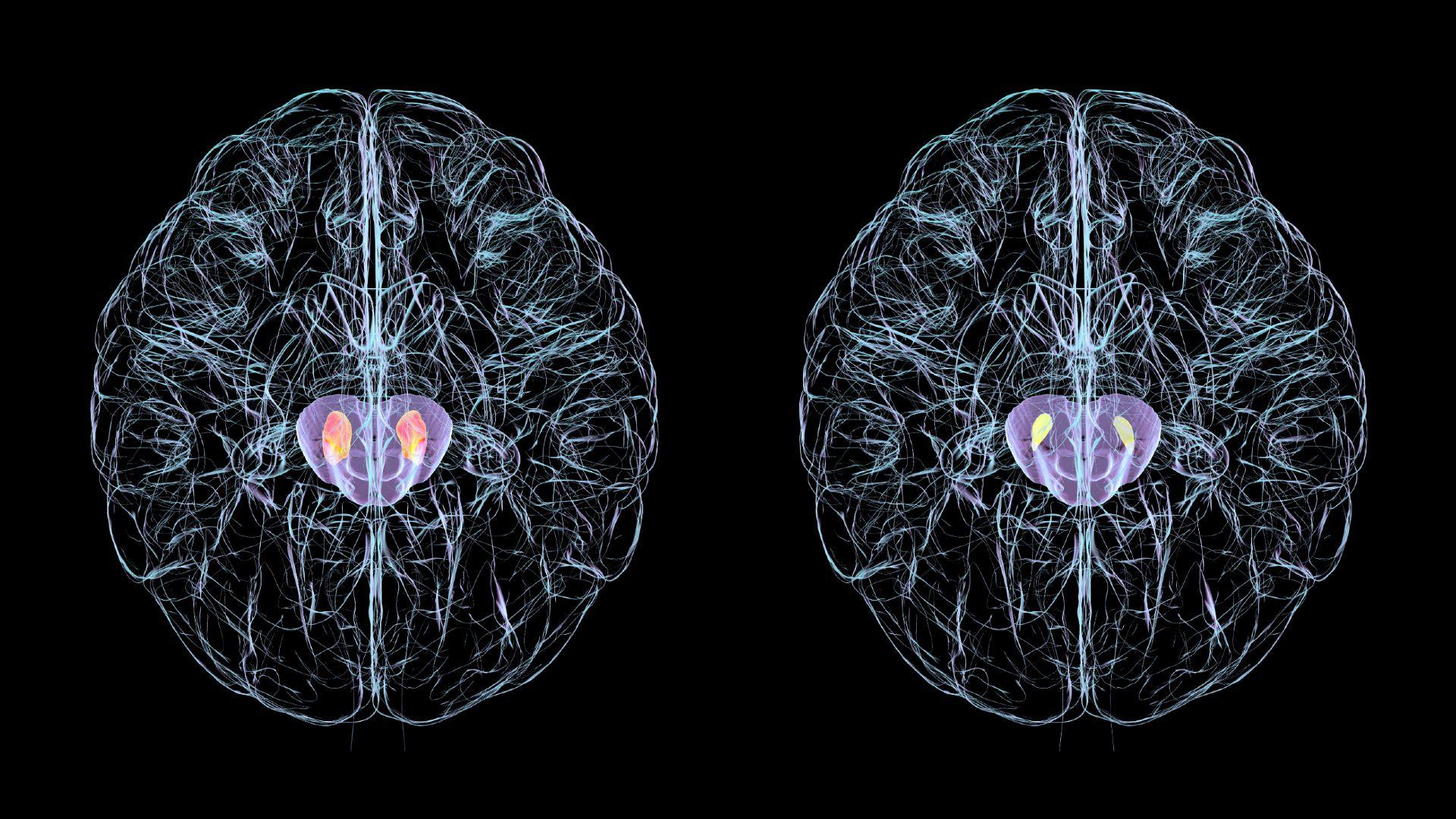 Ilustracija dva mozga, svaki sa dve crne supstance koje su u regionu srednjeg mozga. Sa leve strane, crni segmenti su veći, a sa desne manji