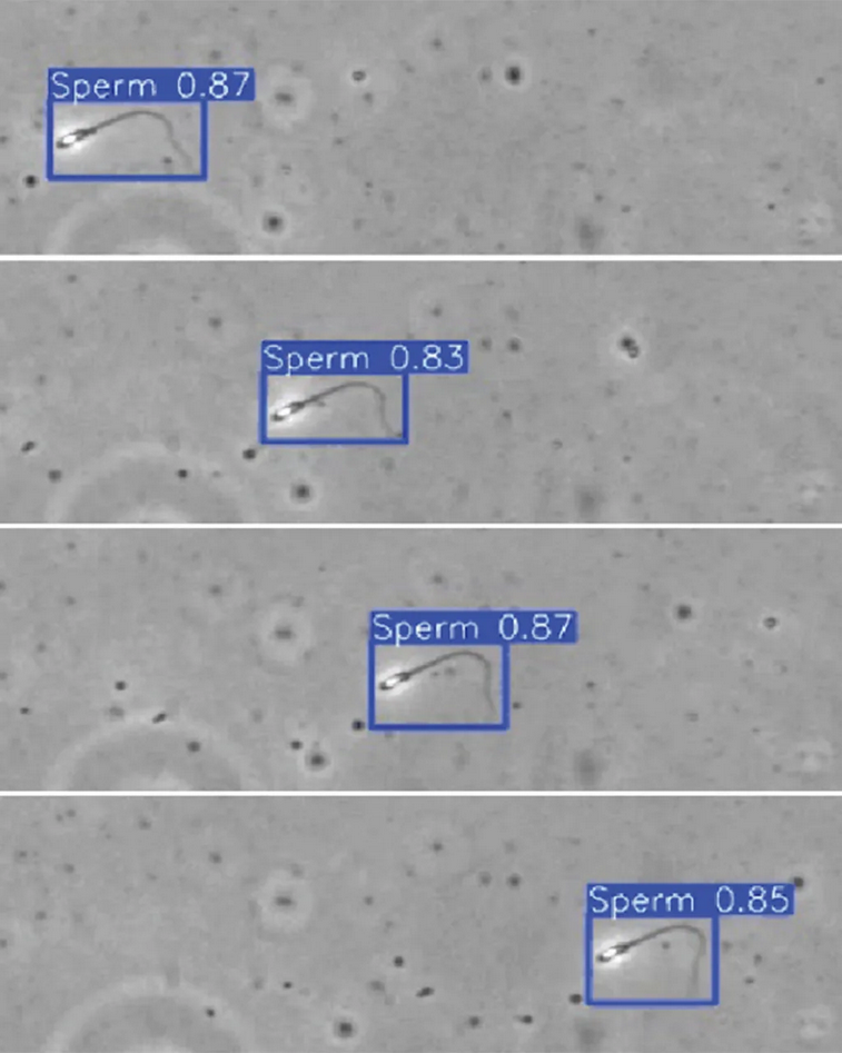spermatozoid na četiri uzorka u spermi koja nema dovoljno semena