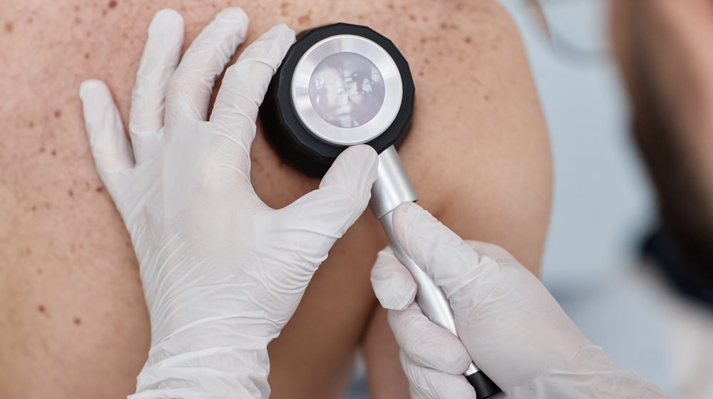 Zašto je Srbija u vrhu Evrope po smrtnosti od melanoma? 15
