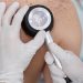 Zašto je Srbija u vrhu Evrope po smrtnosti od melanoma? 1